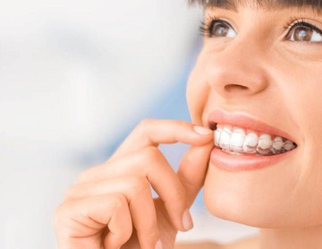 Quanto tempo demora o tratamento com o Invisalign?